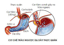 Đông y chữa trào ngược dạ dày thực quản