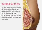 Bài thuốc dân gian chữa tắc sữa (áp xe tuyến vú)
